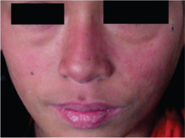 Redness across both cheeks and the bridge of the nose; eyes covered for privacy