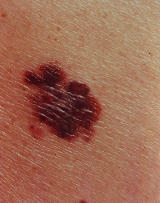 Irregular dark brown and red patch with uneven edges on the skin