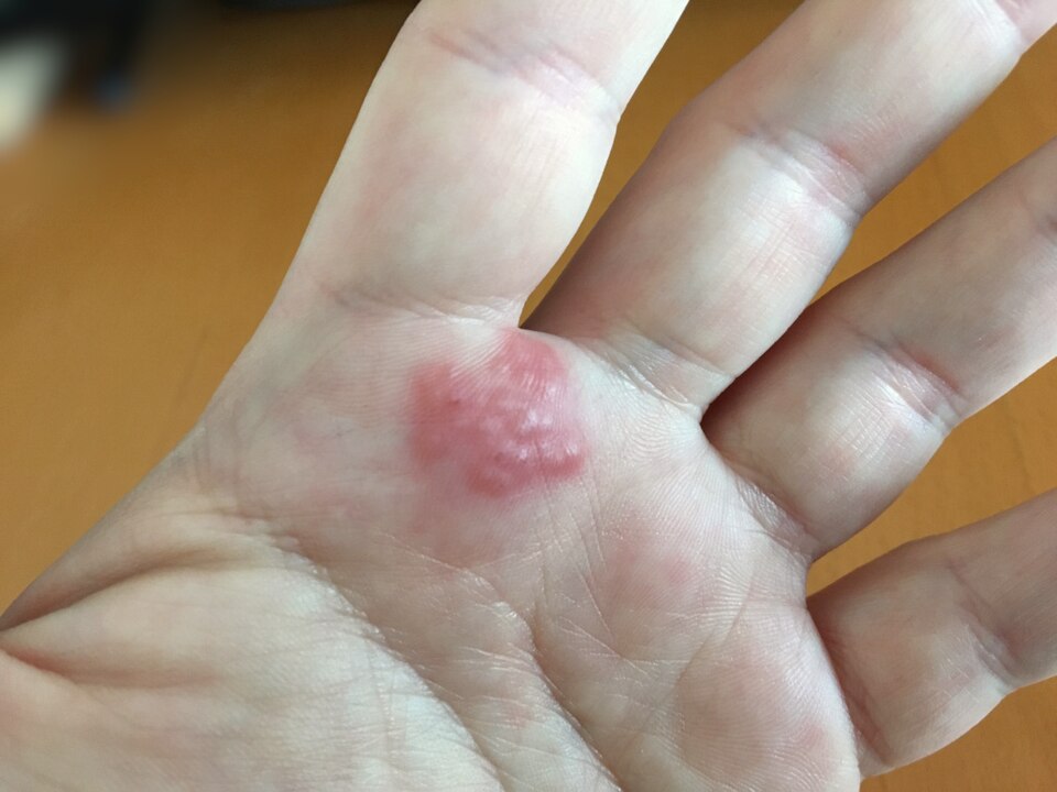 Red, irritated patch on the palm and fingers