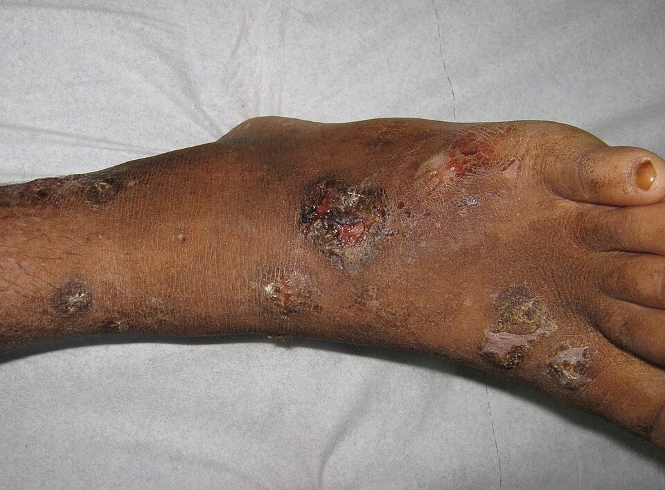 Crusted, scabbed sores on a lower leg and foot