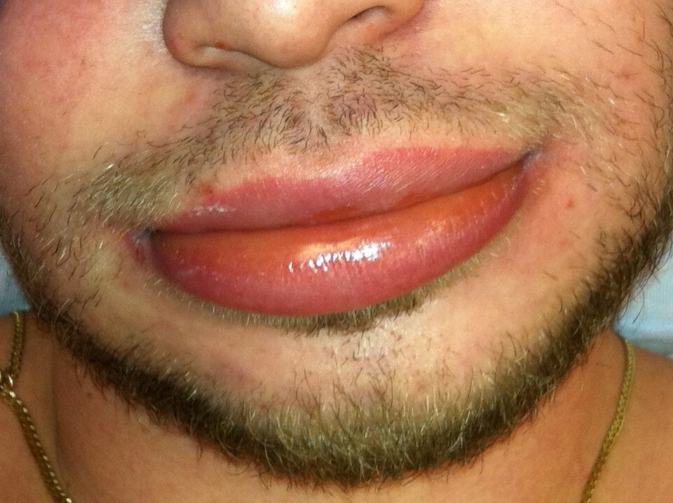 Swollen upper and lower lips