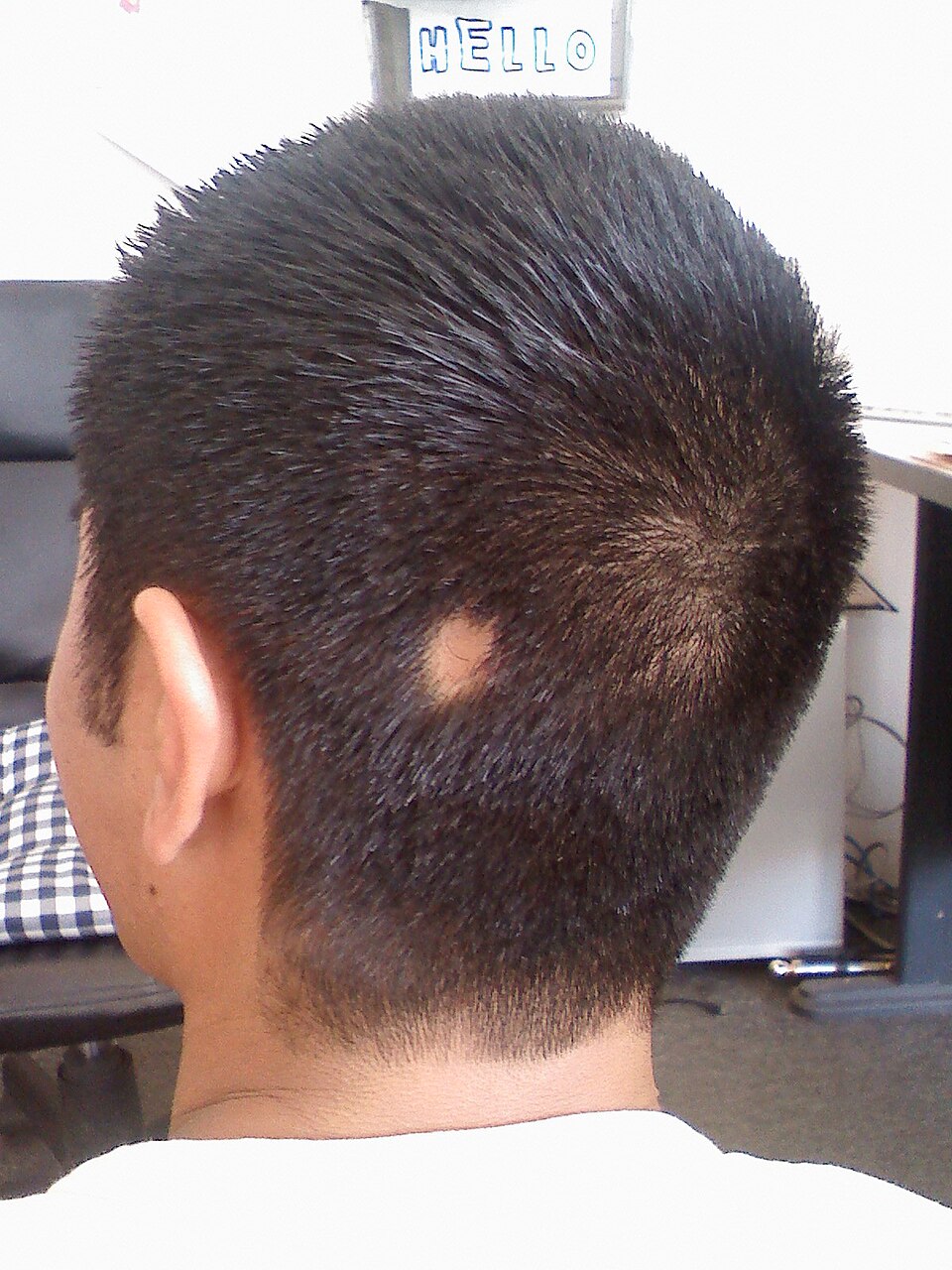 Smooth, round bald patch on the scalp