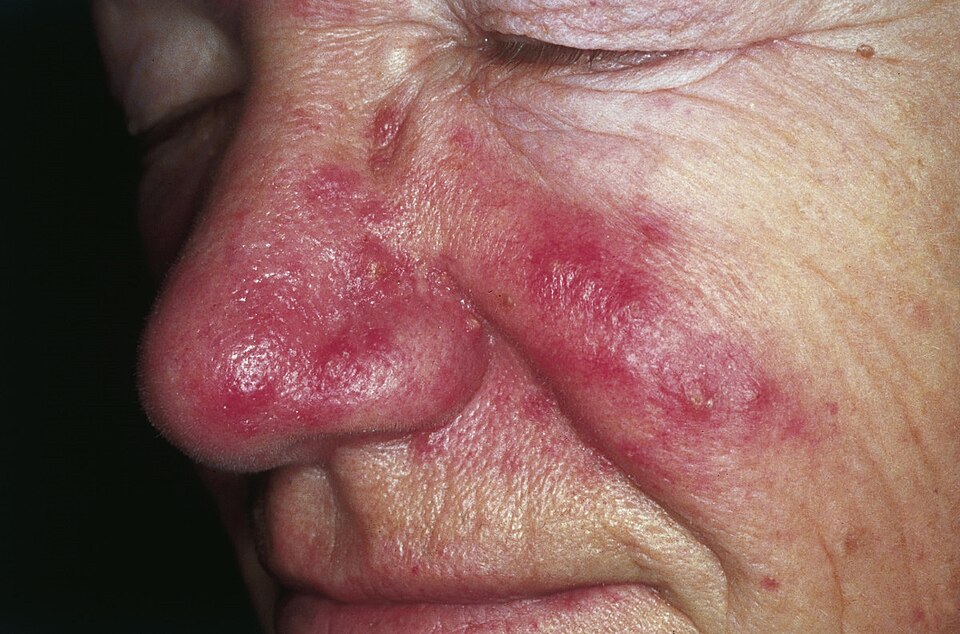 Persistent redness and visible small blood vessels on the nose and cheek