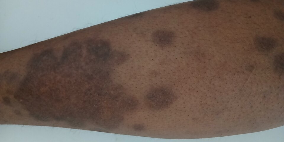 Well-defined darker patches with scale on a lower leg