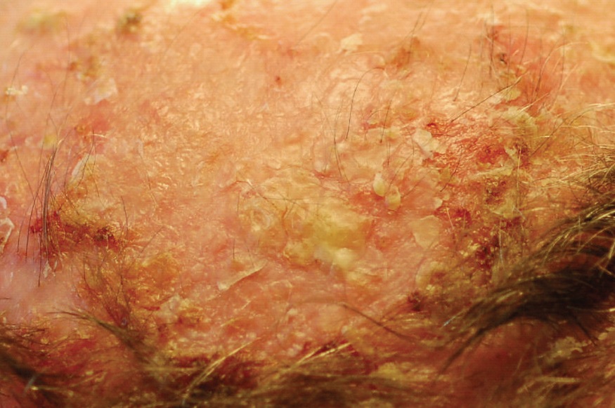 Rough, scaly patches on a sun-exposed scalp