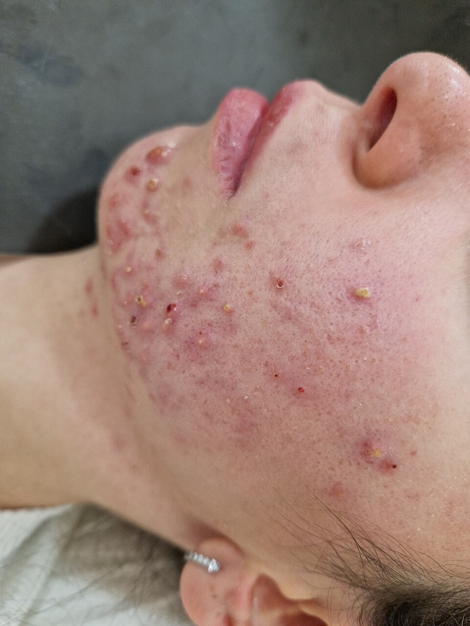 Red, inflamed, deep acne lumps on the cheek and jaw
