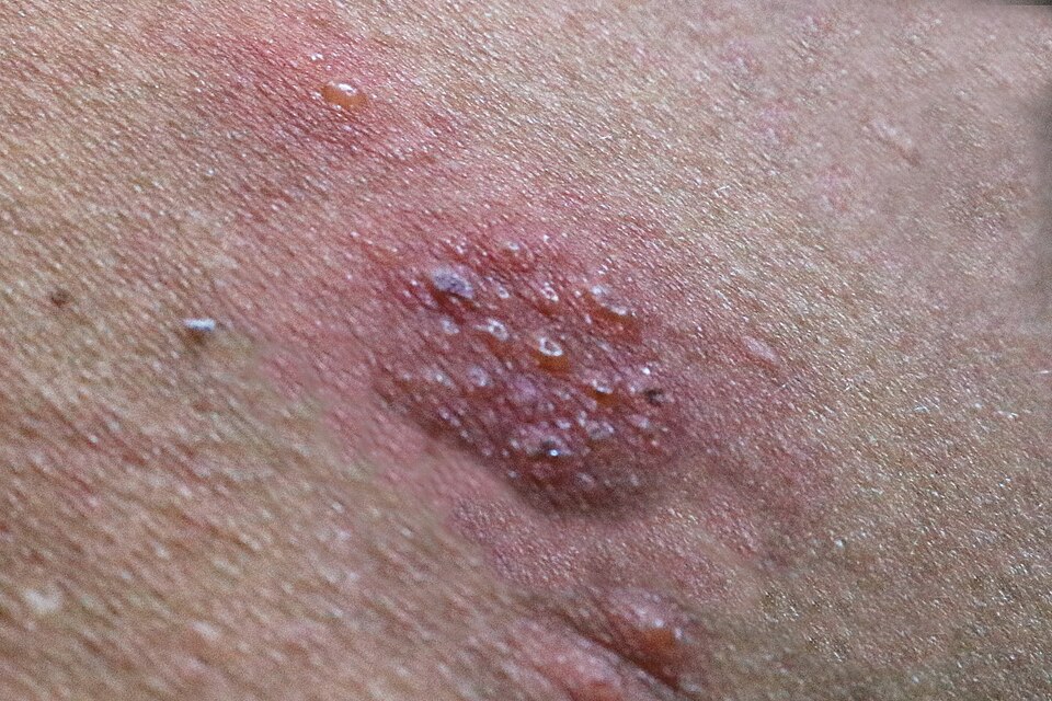 Cluster of small blisters on a red patch of skin