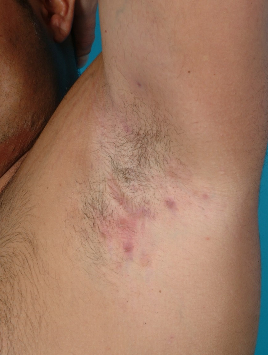 Red, inflamed lumps in the armpit