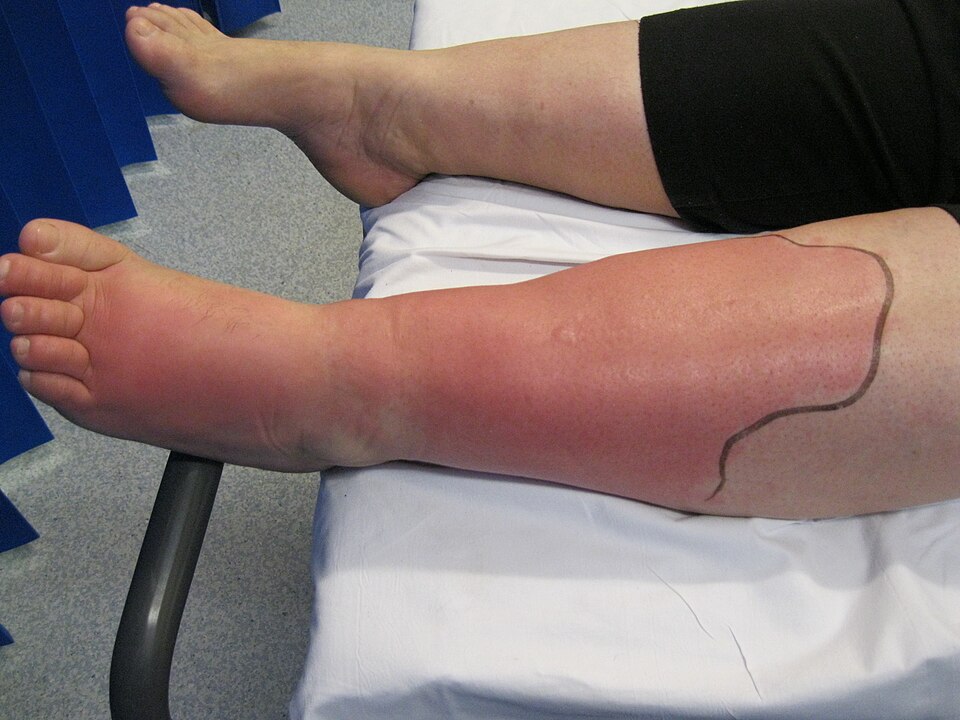 Red, swollen leg with the edge of the redness marked in pen