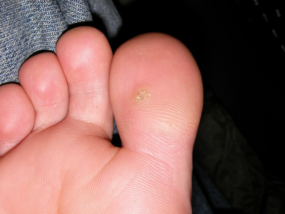 Small rough growth on the sole of the big toe