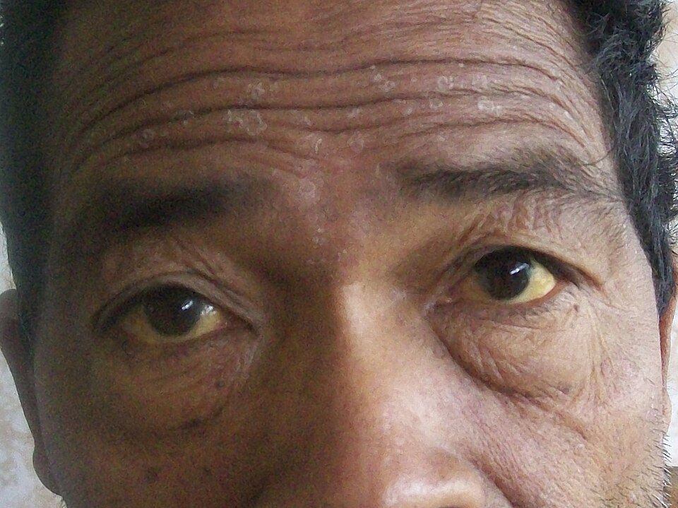 Yellow tint in the white of the eye
